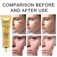 Lanbena Tcm Scar & Acne Mark Removal Gel Ointment - 30g