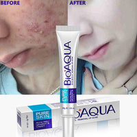 Bioaqua Removal of Acne Cream Pimple Bio Aqua 30g